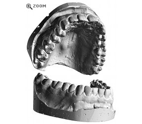 Teeth Cast 3D Scan